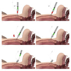 VBM Quicktrach II – Punktionskoniotomie - Set CICO - Critical Knowledge