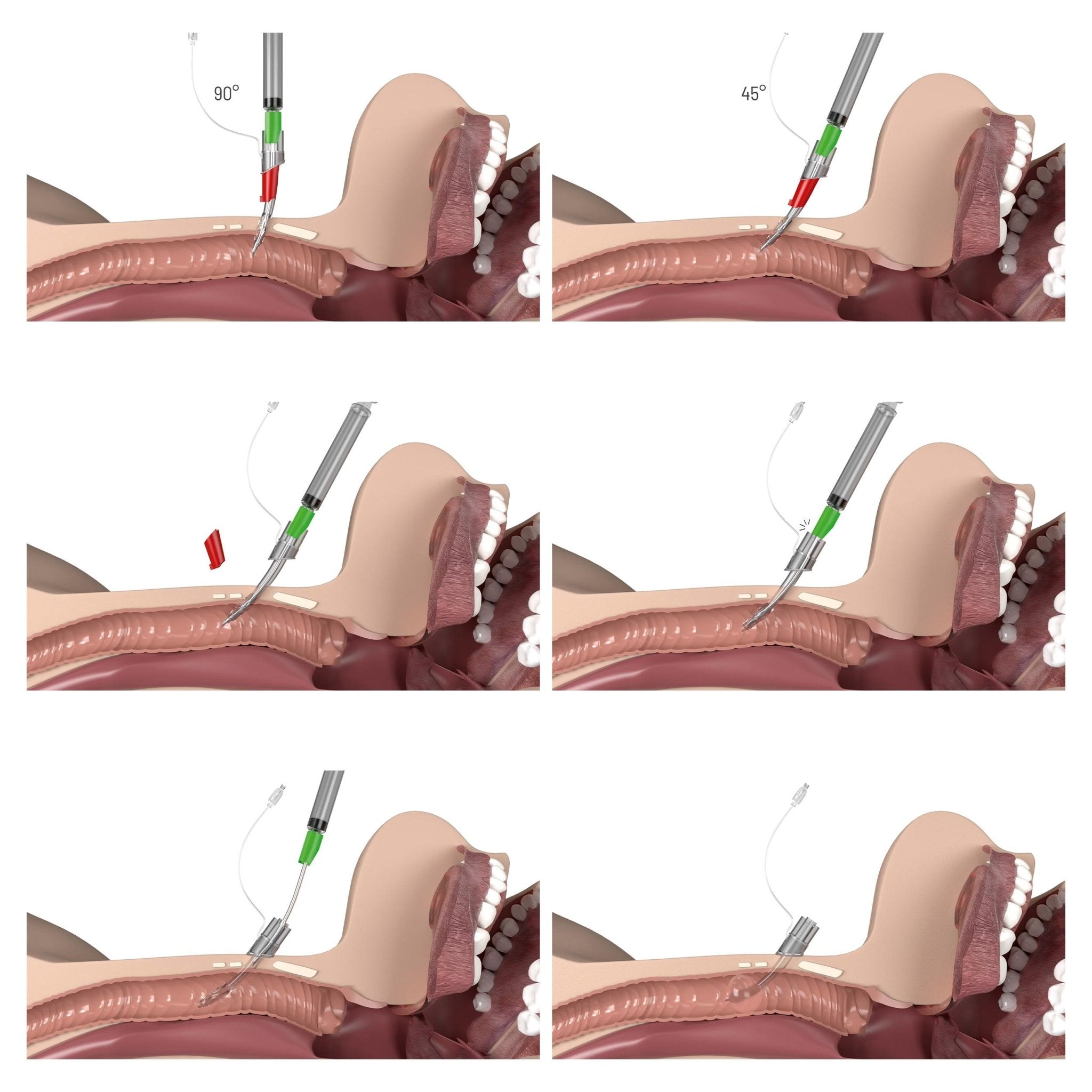 VBM Quicktrach II – Punktionskoniotomie - Set CICO - Critical Knowledge