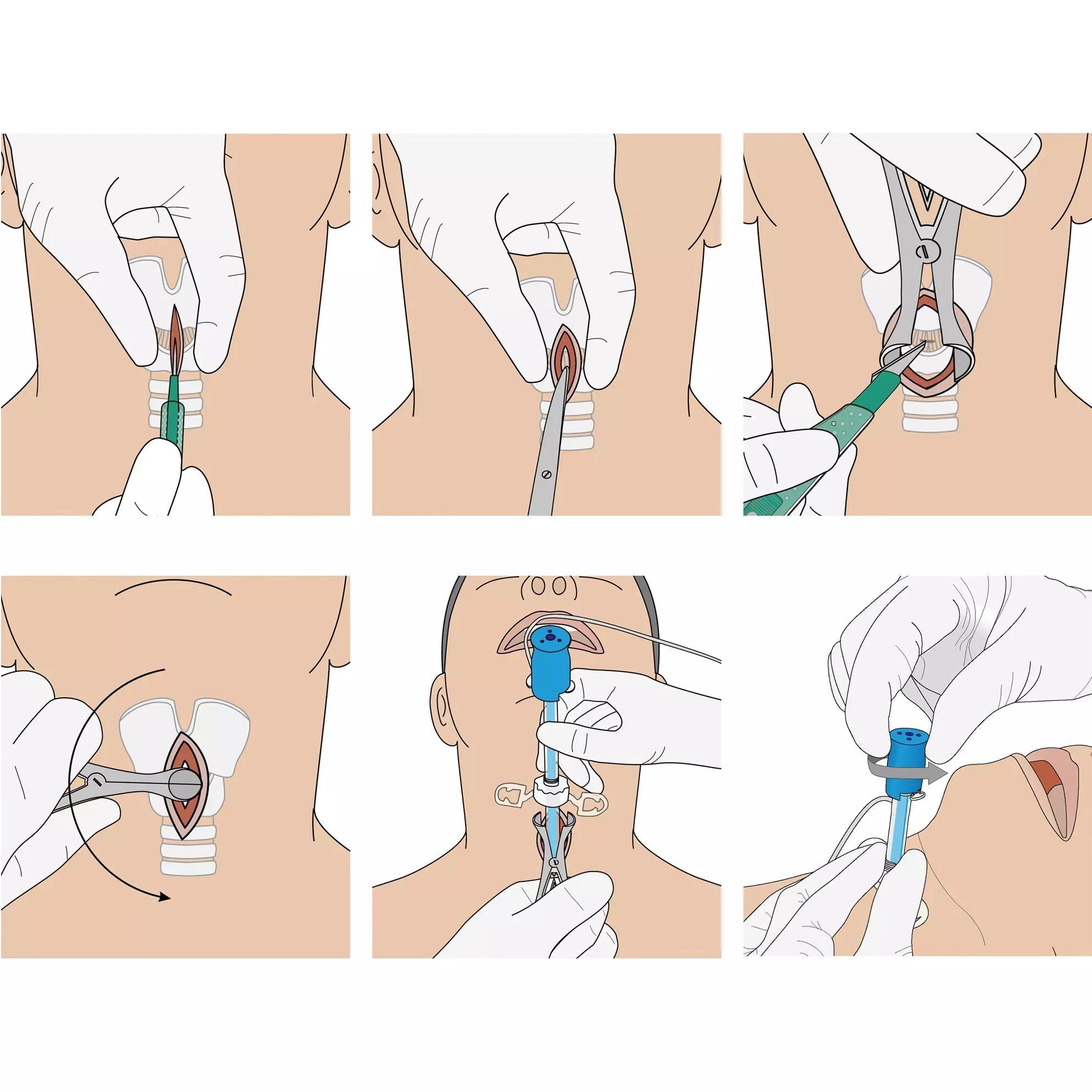 VBM Surgicric II – Chirurgisches Koniotomie - Set - Critical Knowledge